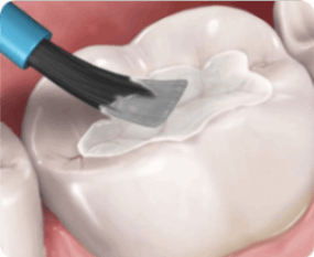 Sealants